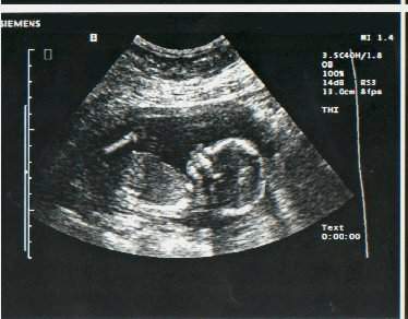 This is another random pear-sized ultrasound baby that looks eerily similar to my ultrasound...