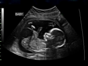 This is a random ultrasound off Google and the profile pic to this post.